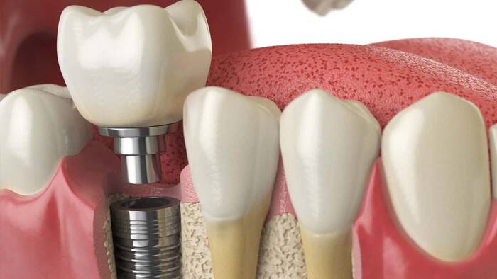 implante-dental - odontologia panama - perfect smile