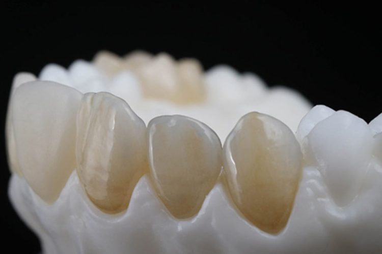 resina-dientes-1280x720-1 - odontologia panama - perfect smile